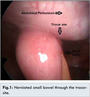 Incisional Hernia At Trocar Port Site